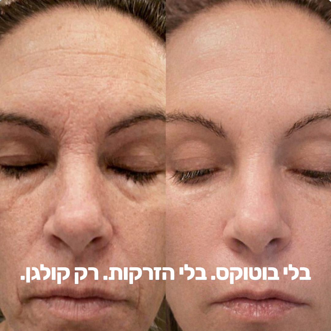 בוטוקס-סטיק: אפקט המילוי המיידי