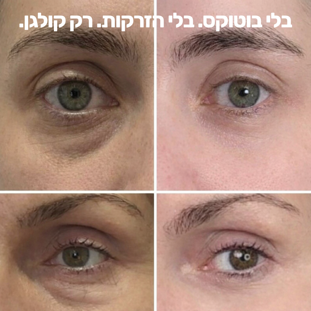 בוטוקס-סטיק: אפקט המילוי המיידי