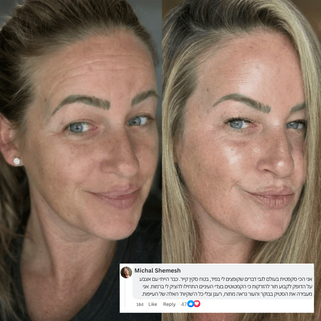 בוטוקס-סטיק: אפקט המילוי המיידי