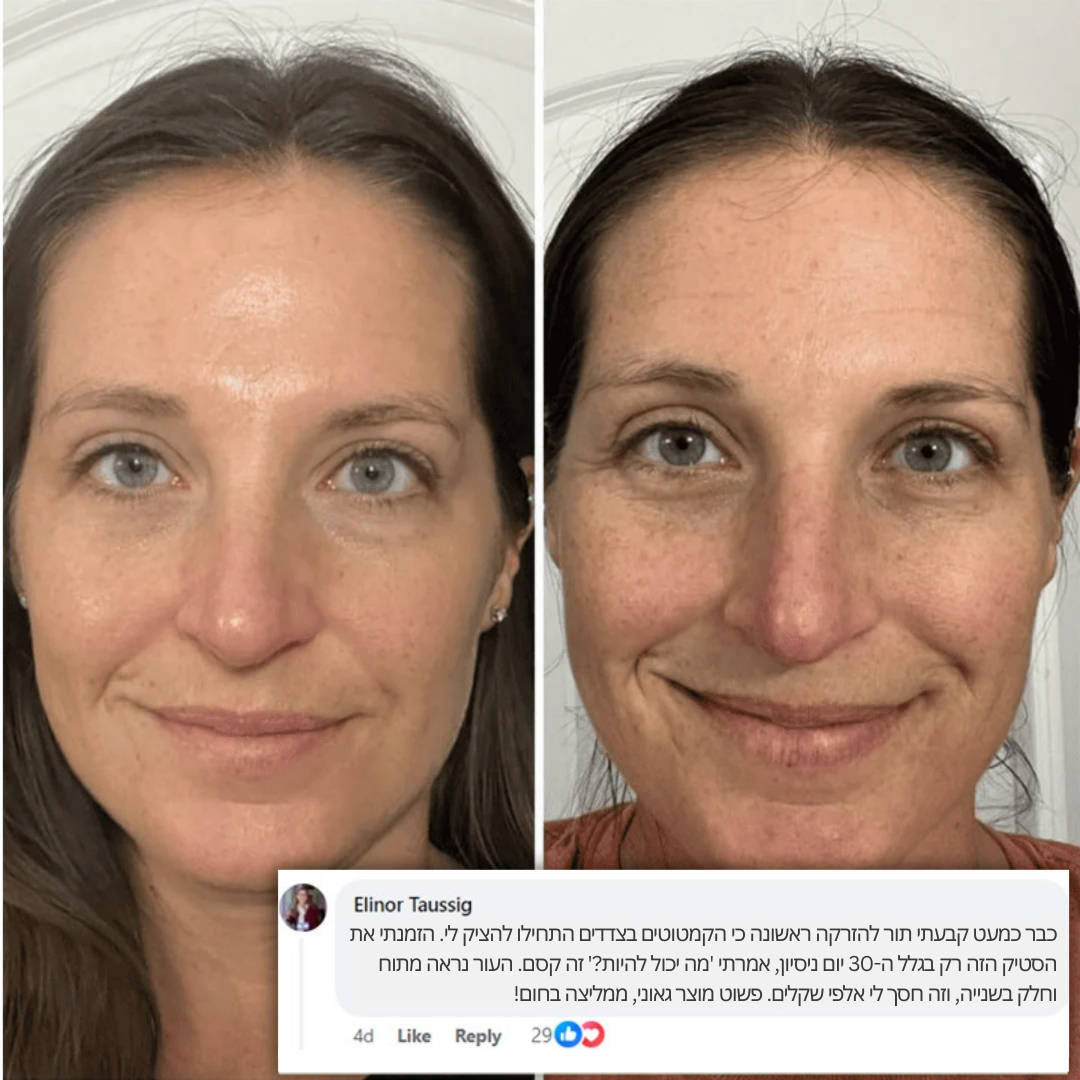 בוטוקס-סטיק: אפקט המילוי המיידי