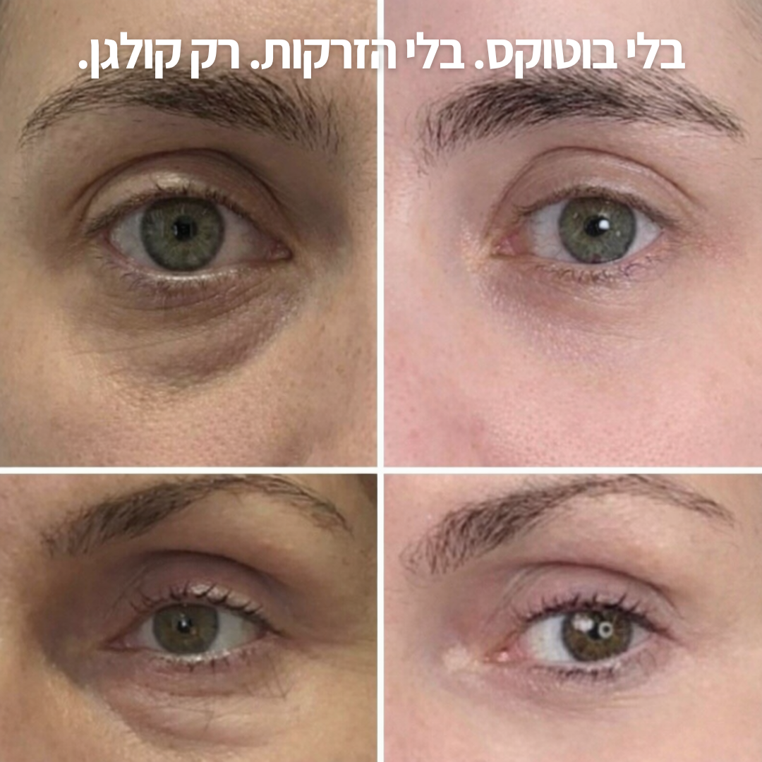 בוטוקס-סטיק: אפקט המילוי המיידי